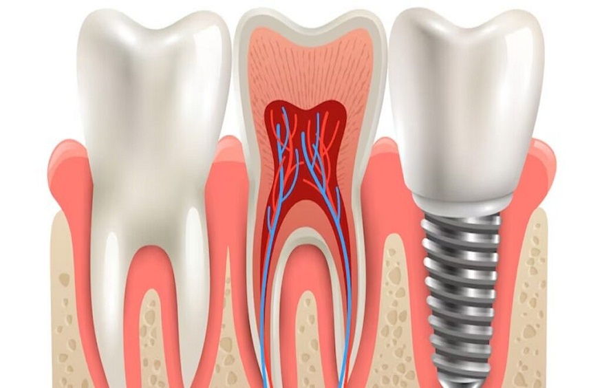 Misconceptions About Root Canals