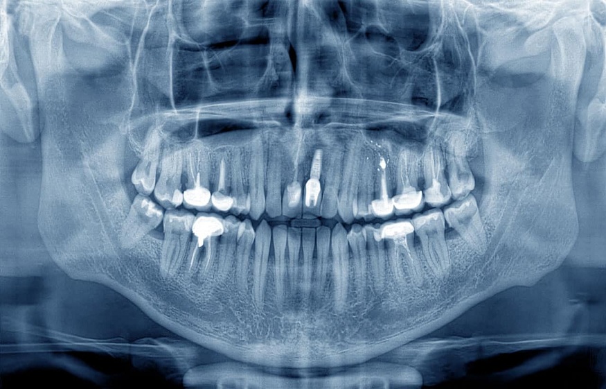 Dental X-Rays