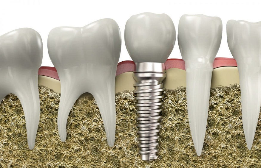 Prevent Peri-Implantitis