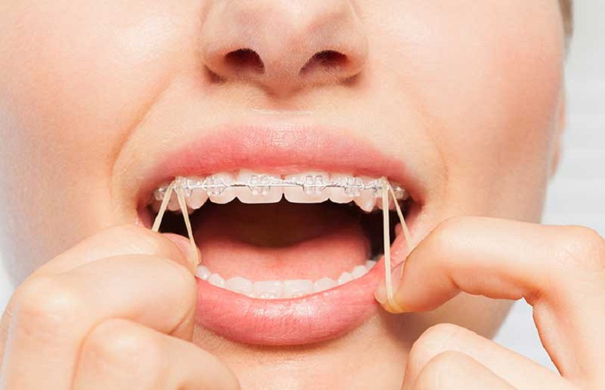 Science Behind The Movement Of Teeth